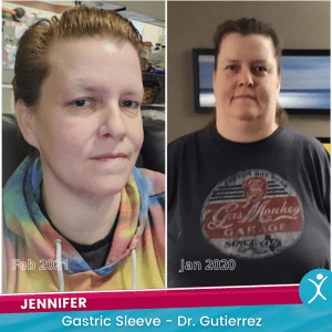 Jennifer R Before and After Picture - gastric sleeve - Dr G