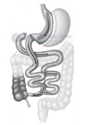 Duodenal-Switch, home page
